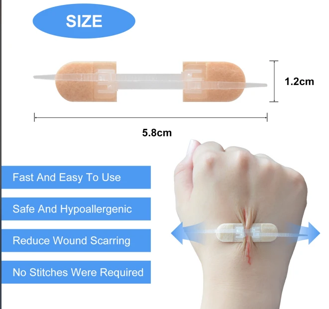 wound closure device wound closure device